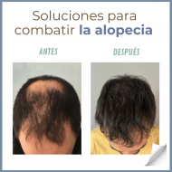 Cómo frenar la caída del cabello: soluciones para combatir la alopecia