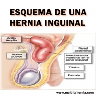 Las mejores fajas para la hernia inguinal