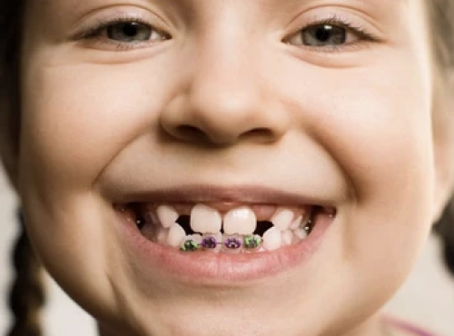 El Centre Dental Francesc Macià explica en qué consiste un tratamiento de ortodoncia infantil y sus posteriores benefici