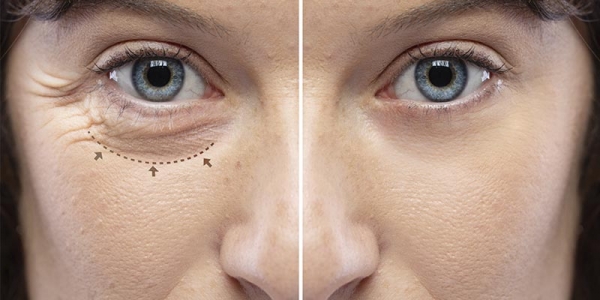 Blefaroplastia: tu guía completa para una mirada radiante