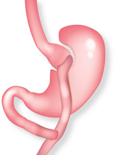 Gastric bypass